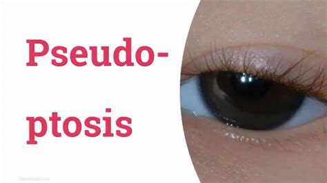 pseudoptosis adalah  Mild ptosis may not be very noticeable nor cause any vision problems